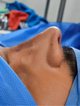Head & Neck Surgery After