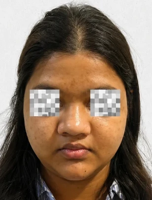 Open Rhinoplasty Before