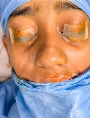 Scarless Rhinoplasty Before