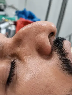 Head & Neck Surgery Before