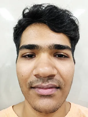 Scarless Rhinoplasty Before