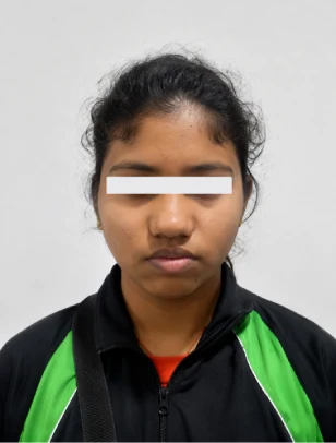 Rhinoplasty & Sinus Surgery Before